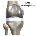 India Surgery Simultaneous Bilateral Knee Replacement, Both Knee Replacement Together Surgery